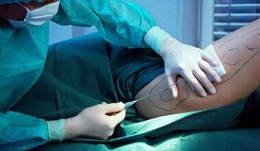 The weight loss surgery